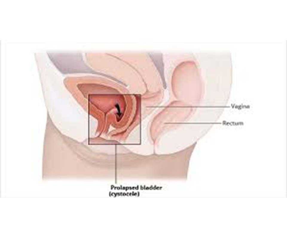 Vaginal Prolapse